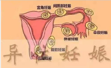 异位妊娠预防知识