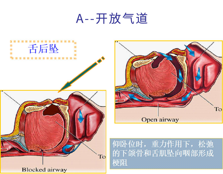 A--开放气道.jpg